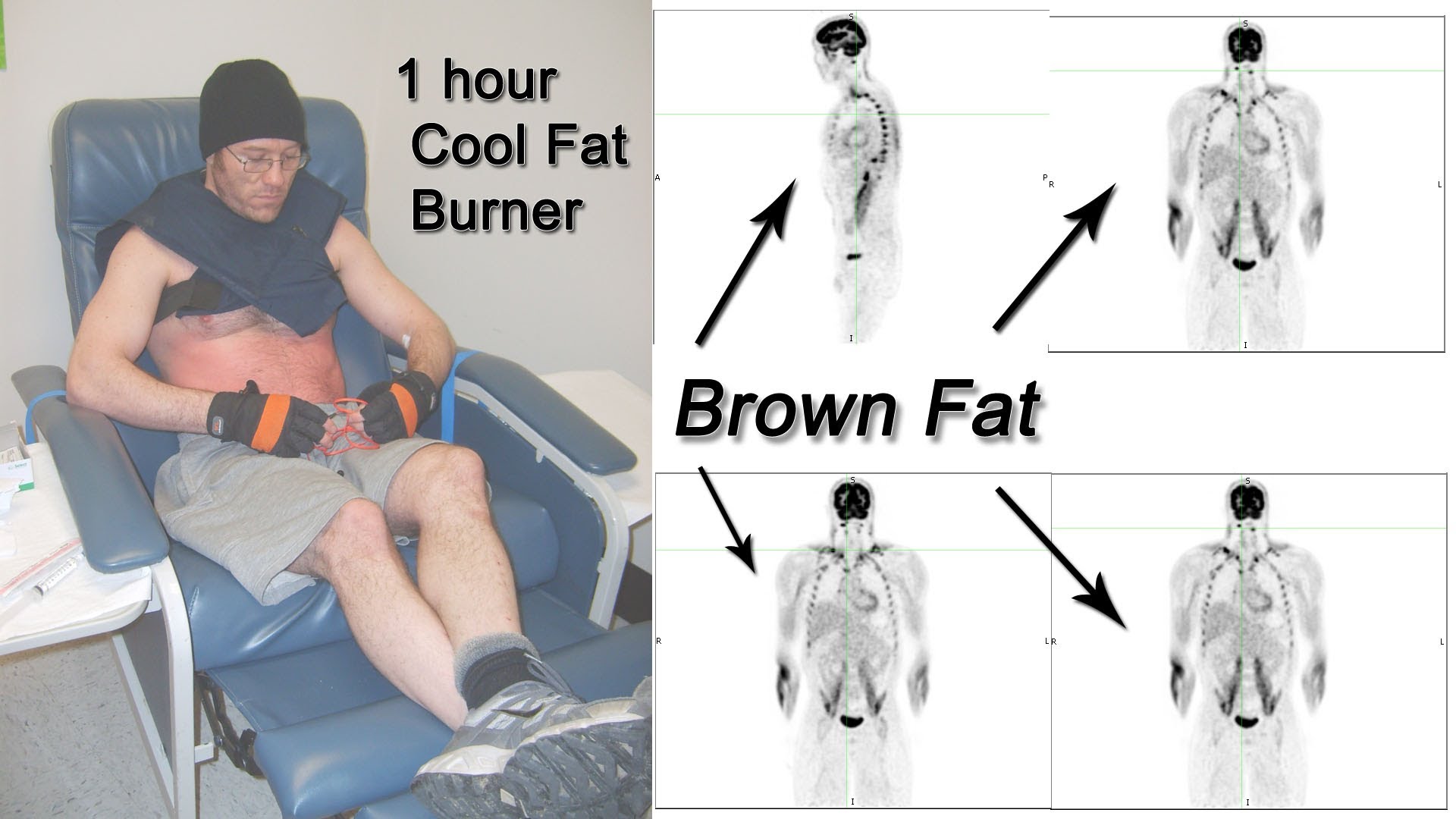 The Cool Fat Burner activates brown fat!